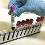 Pocet pacientov so zltackou stupa hlasia 20 hospitalizovanych