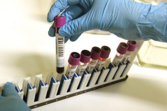 Pocet pacientov so zltackou stupa hlasia 20 hospitalizovanych