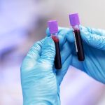 Krvny test na Alzheimerovu chorobu je na trhu