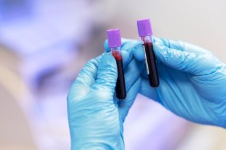 Krvny test na Alzheimerovu chorobu je na trhu