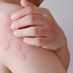 Svrbive vyraky sa objavia v priebehu minut Chlad moze spustit aj zivot ohrozujuCLU reakciu