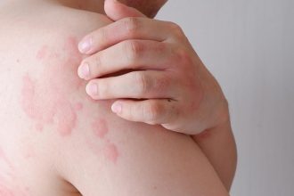 Svrbive vyraky sa objavia v priebehu minut Chlad moze spustit aj zivot ohrozujuCLU reakciu