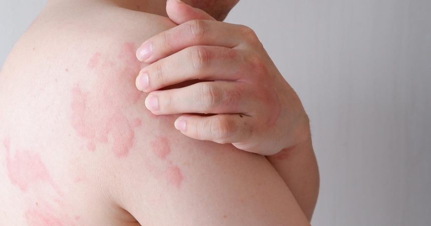 Svrbive vyraky sa objavia v priebehu minut Chlad moze spustit aj zivot ohrozujuCLU reakciu