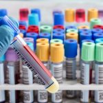 castesie ou trpia predkovia keltov no postihuje aj slovakov nelieena hemochromatoza moze vies k cirhoze pecene