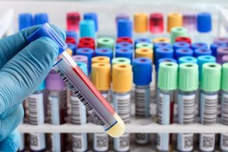 castesie ou trpia predkovia keltov no postihuje aj slovakov nelieena hemochromatoza moze vies k cirhoze pecene