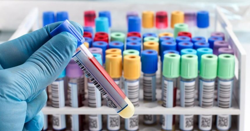 castesie ou trpia predkovia keltov no postihuje aj slovakov nelieena hemochromatoza moze vies k cirhoze pecene