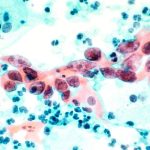 Preco niektore drobne nadory zmiznu a ine rastu Klucove je ako na ne reaguje okolie