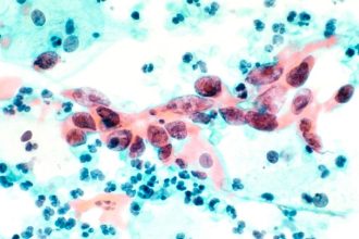 Preco niektore drobne nadory zmiznu a ine rastu Klucove je ako na ne reaguje okolie